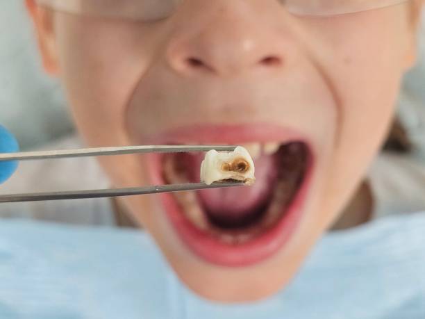 Best Emergency Treatment for Toothache in Bluffton, OH