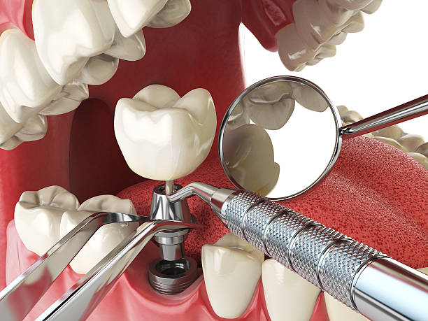 Best Emergency Tooth Extraction in Bluffton, OH